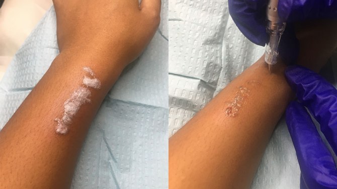 nikki-tattoo-removal-2