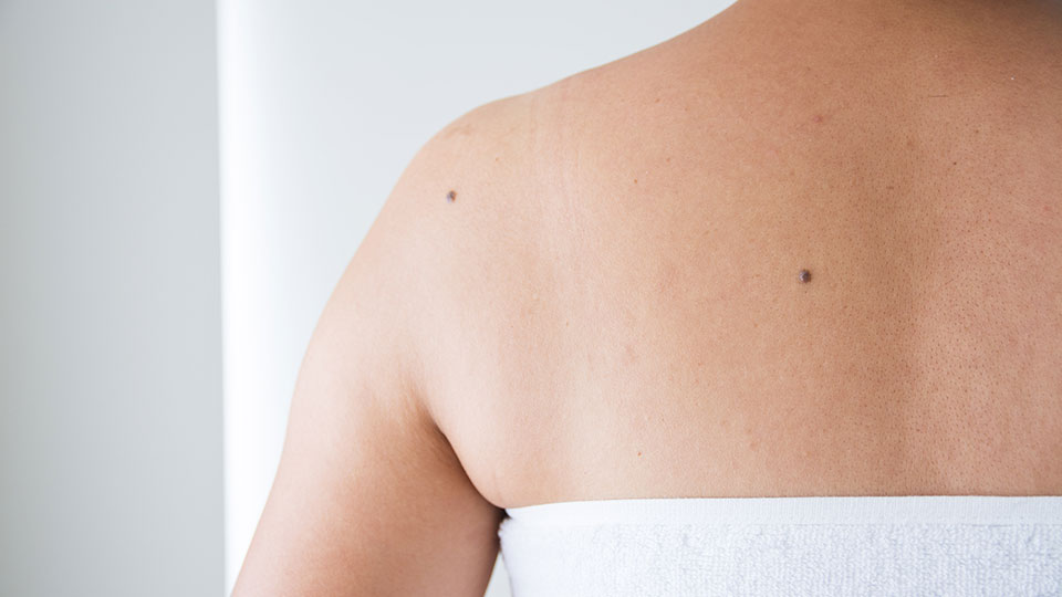 best tea tree oil for skin tags