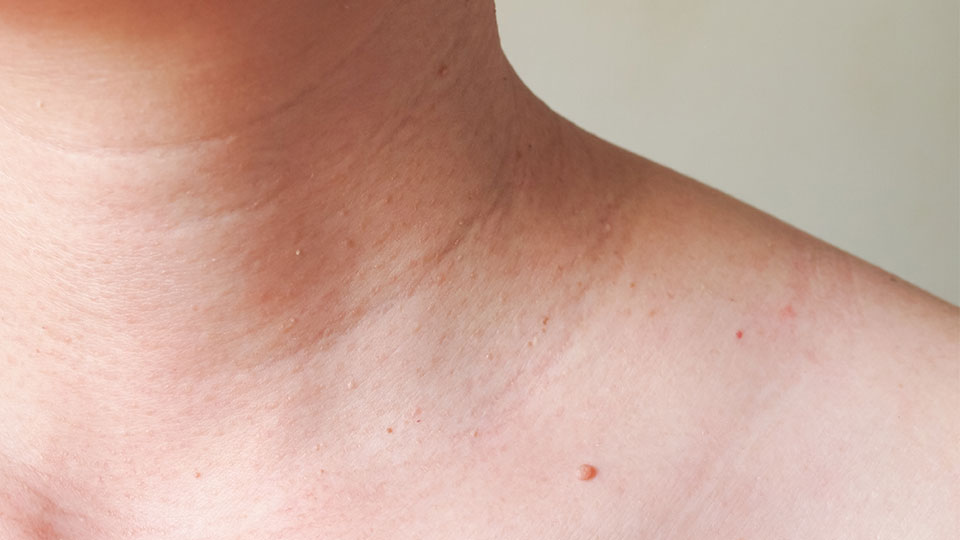 skin tag facts